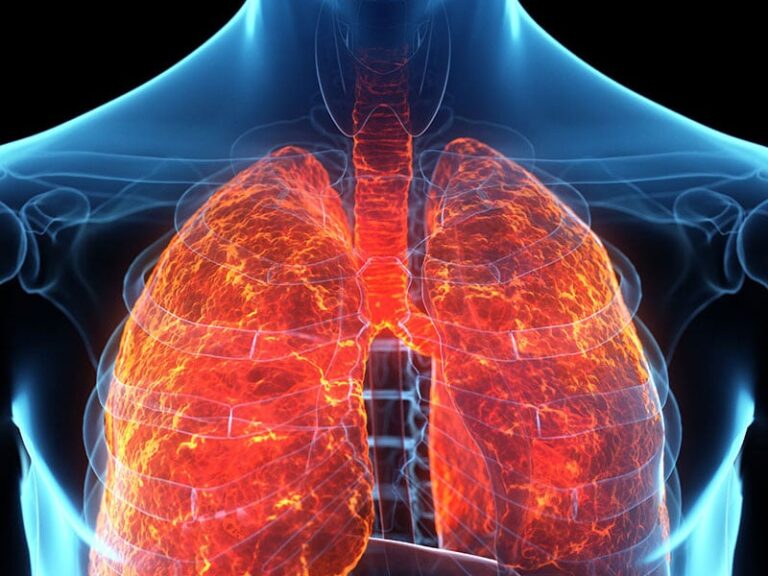 Signs of Asbestos Exposure