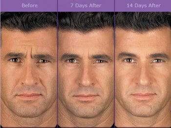 What to Expect Before and After Getting Botox in Brandon