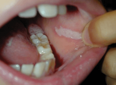 How to Stop Biting Inside of Cheek